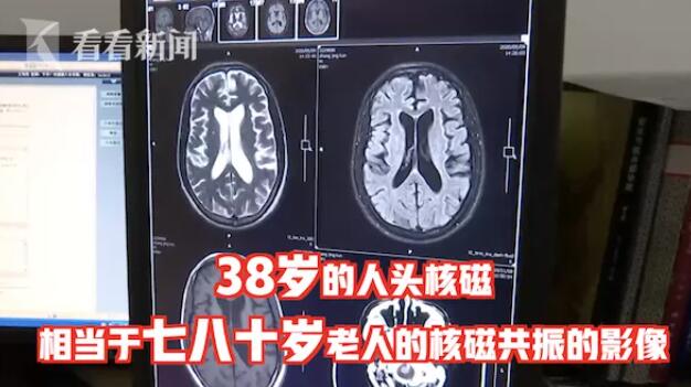 38岁男子“痴呆晚期”竟是梅毒所致