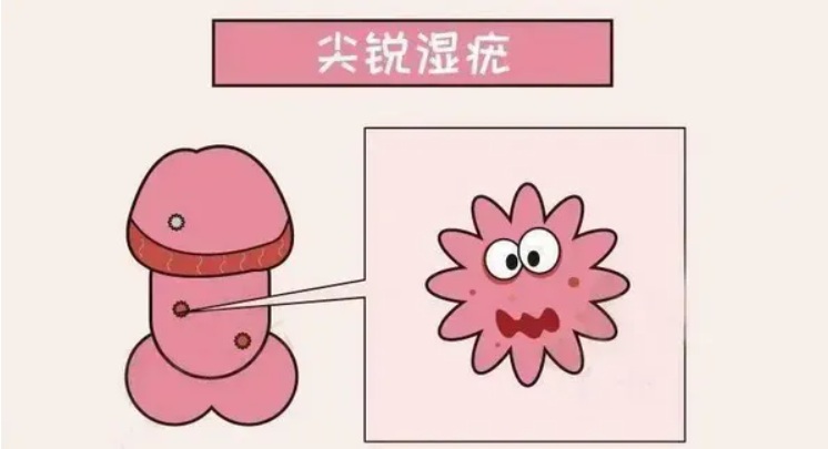 【双语】《这个不痛不痒的溃疡，可能是梅毒警报！》   «بۇ ئاغرىمايدىغان جاراھەت، سىفلىسنىڭ ئاگاھلاندۇرۇشى بولۇشى مۇمكىن!ن » 