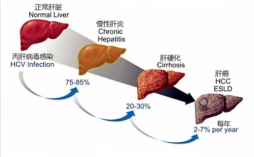 【双语】丙肝是唯一能彻底治愈的病毒性肝炎，这7类高危人群请尽早筛查 C تىپلىق جىگەر ياللۇغى بىردىنبىرساقايتقىلى بولىدىغان جىگەر ياللۇغى
