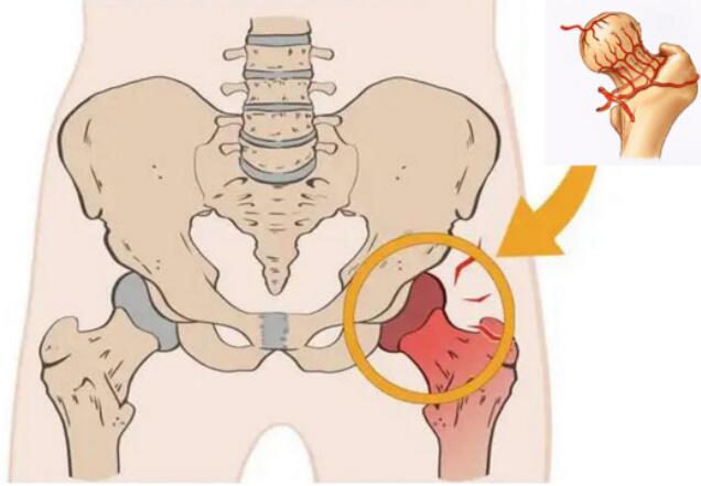 艾滋病患者如何预防股骨头坏死？做好这些措施尤其重要！