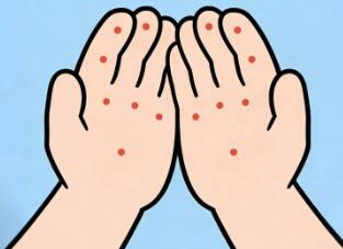 日本梅毒扩散！连续4年超1.3万例！必看