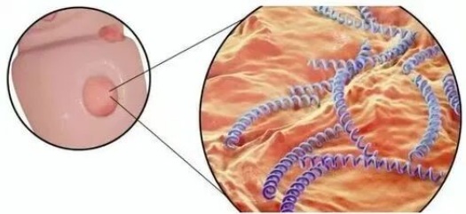 【双语】《梅毒》 « سىفلىس »
